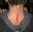 The scar on Dave Haarstad’s neck after his surgical fusion